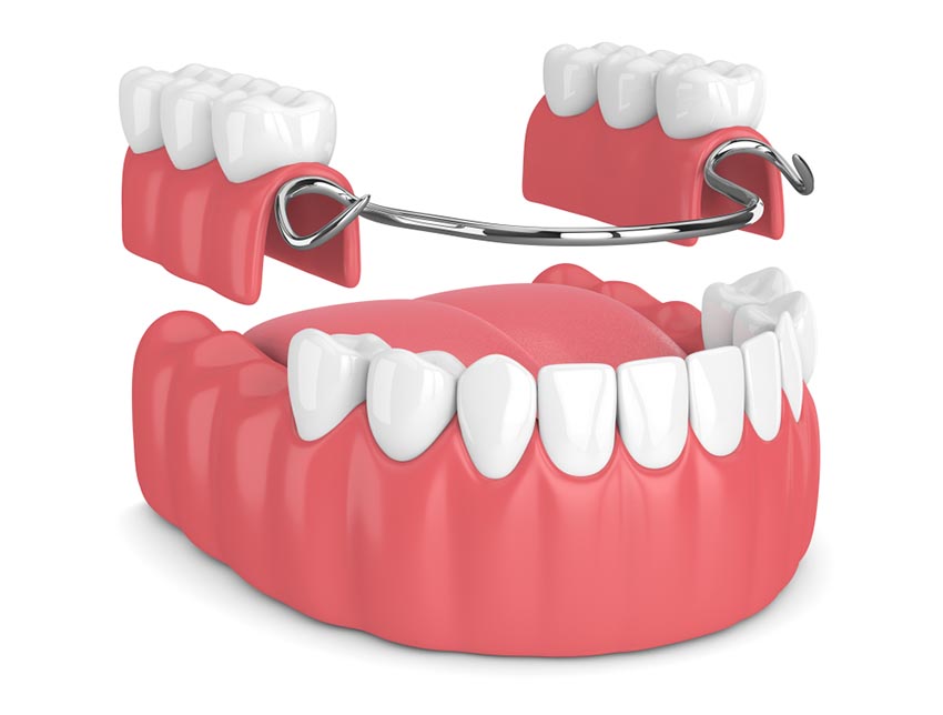Benefits of Partial Dentures