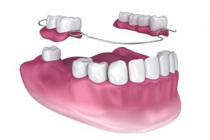 Partial Dentures vs Implants