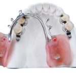 Precision Attachment Partial Dentures