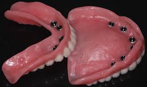Implant Dentures Fredericksburg