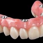 implant dentures with framework