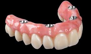 Implant Dentures Fredericksburg