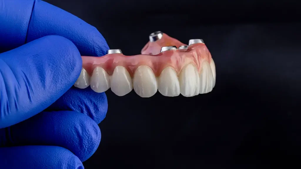 Gloved hand holding a dental implant denture